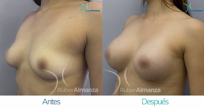 antes-y-despues-mamoplastia-de-aumento-ruber-almanza-bogota-colombia-ng-diagonal-izquierdo