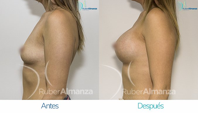 antes-y-despus-mamoplastia-de-aumento-ruber-almanza-bogota-colombia-mae-lateral-izquierdo
