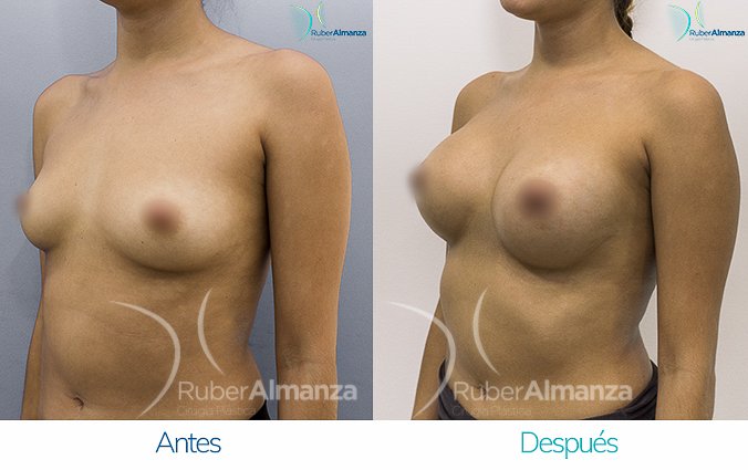 antes-y-despues-mamoplastia-de-aumento-ruber-almanza-bogota-colombia-nc-diagonal-izquierdo