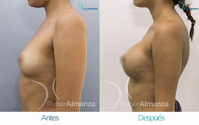 antes-y-despues-mamoplastia-de-aumento-ruber-almanza-bogota-colombia-nc-lateral-izquierdo