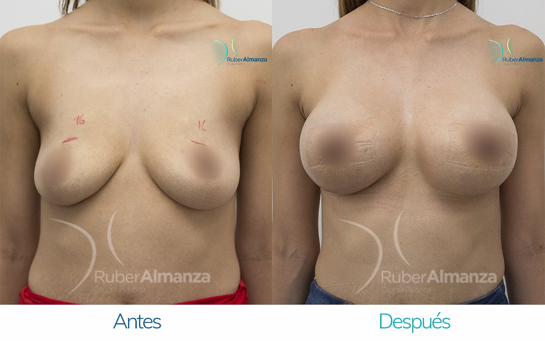 Levantamiento de busto Periareolar con implantes Antes y despues Ruber Almanza Bogota Colombia KG Frontal