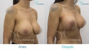 levantamiento-de-busto-t-invertida-con-implantes-antes-y-despues-ruber-almanza-bogota-colombia-au-diagonal-derecho