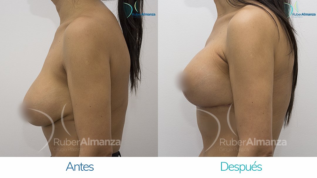 Levantamiento de busto T Invertida con implantes Antes y despues Ruber Almanza Bogota Colombia AU Lateral Izquierdo