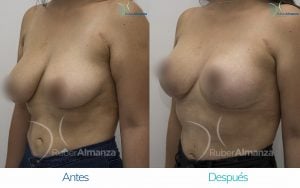 levantamiento-de-busto-t-invertida-con-implantes-antes-y-despues-ruber-almanza-bogota-colombia-pa-diagonal-izquierdo