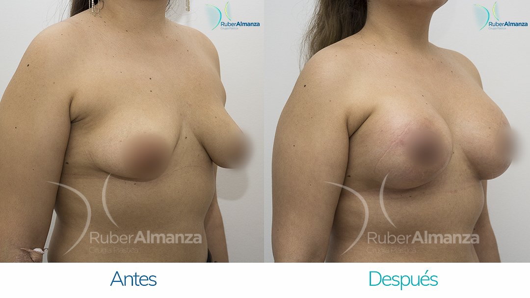 Pexia Periareolar con implantes Antes y despues Ruber Almanza Bogota Colombia EVR Diagonal Derecho