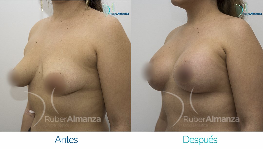 Pexia Periareolar con implantes Antes y despues Ruber Almanza Bogota Colombia EVR Diagonal Izquierdo
