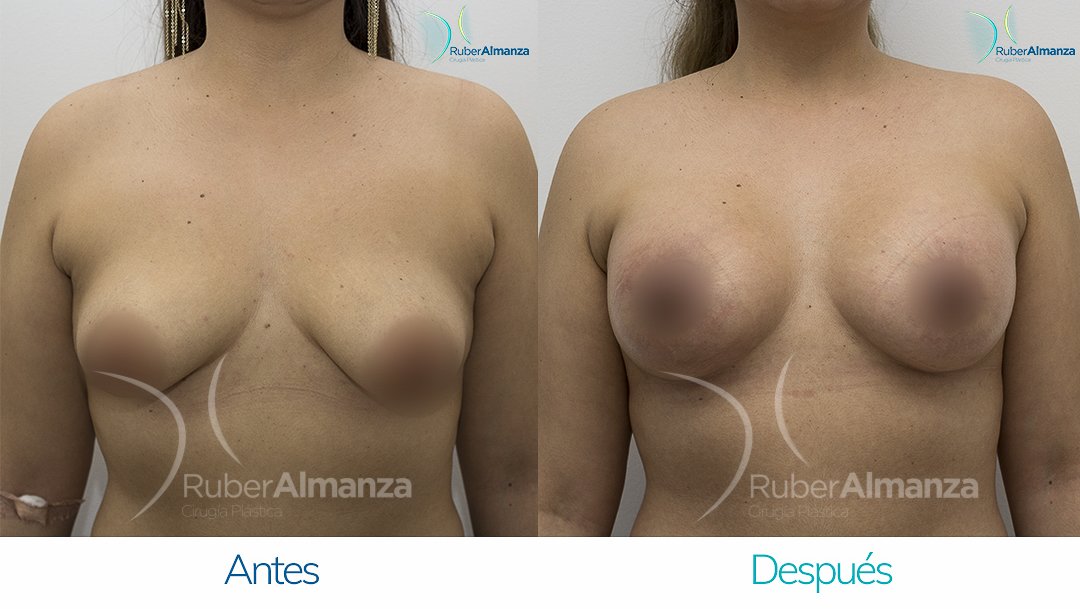 Pexia Periareolar con implantes Antes y despues Ruber Almanza Bogota Colombia EVR Frontal