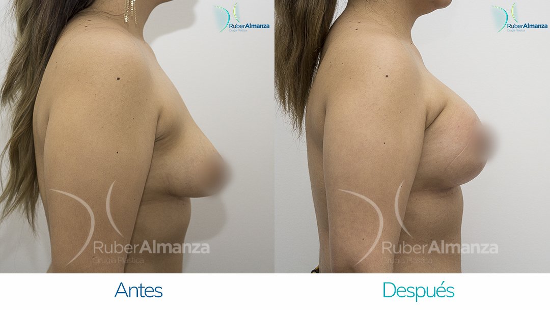 Pexia Periareolar con implantes Antes y despues Ruber Almanza Bogota Colombia EVR Lateral Derecho