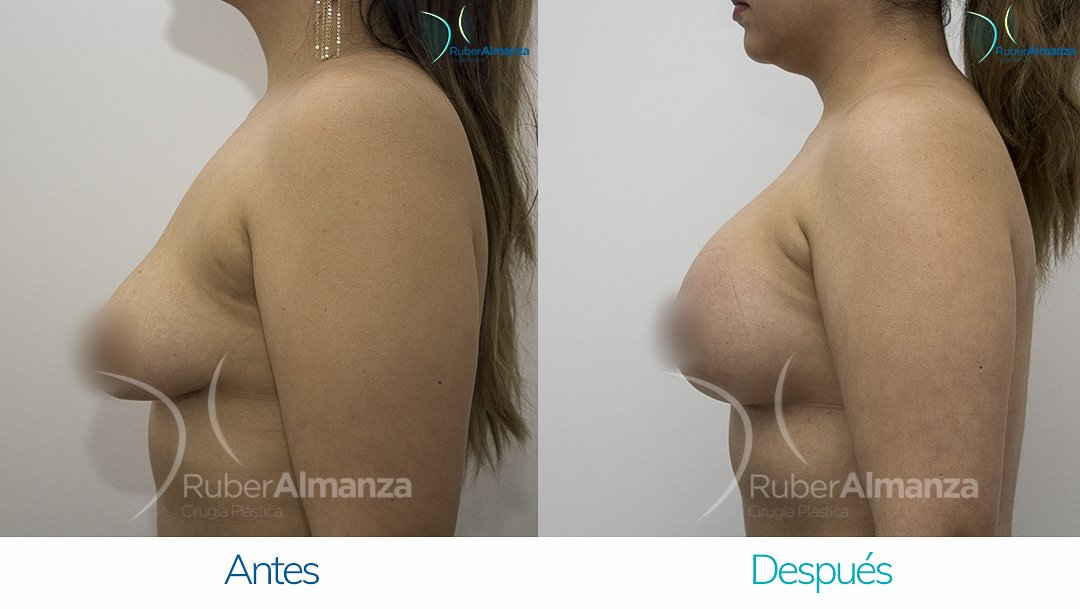 Pexia Periareolar con implantes Antes y despues Ruber Almanza Bogota Colombia EVR Lateral Izquierdo