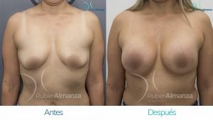 Pexia Periareolar con implantes Antes y despues Ruber Almanza Bogota Colombia MCN Frontal.