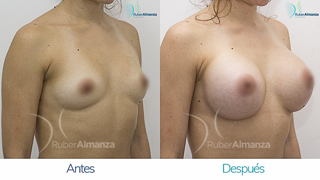 Mamoplastia De Aumento Antes y despues Bogota Ruber Almanza DQ Diagonal Izquierdo
