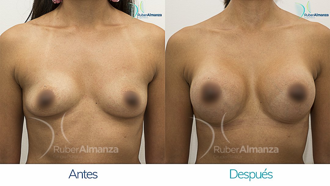 Mamoplastia De Aumento Antes y despues Bogota Ruber Almanza LR Frontal