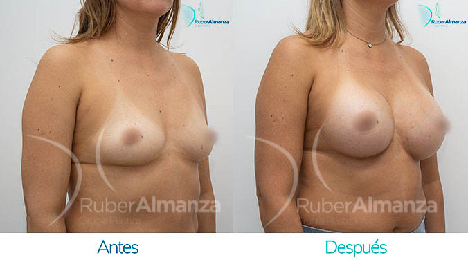 antes-y-despues-mamoplastia-bogota-colombia-dr-ruber-almanza-aa-diagonal-derecho