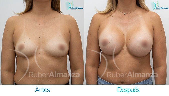 antes-y-despues-mamoplastia-bogota-colombia-dr-ruber-almanza-aa-frontal