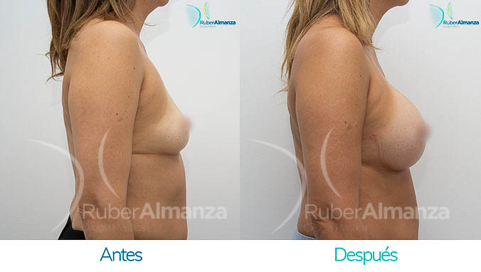 antes-y-despues-mamoplastia-bogota-colombia-dr-ruber-almanza-aa-lateral-derecho