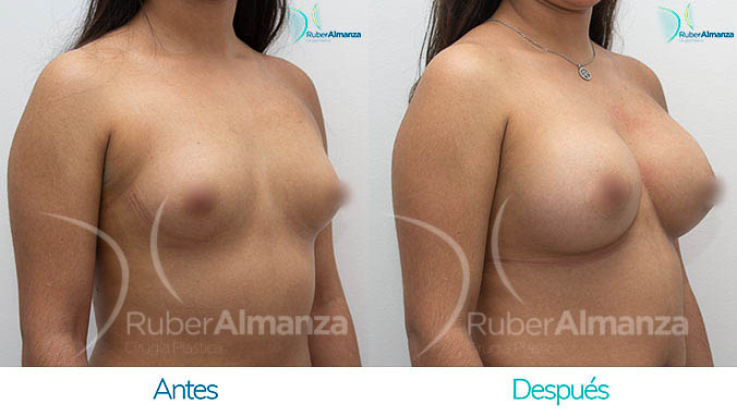 antes-y-despues-mamoplastia-bogota-colombia-dr-ruber-almanza-ale-diagonal-derecho