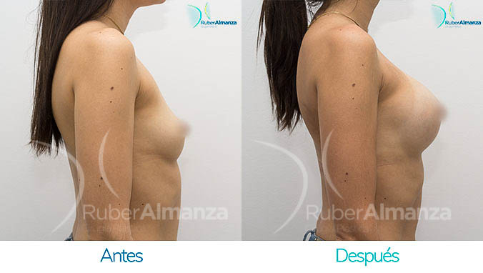 antes-y-despues-mamoplastia-bogota-colombia-dr-ruber-almanza-cl-lateral-derecho