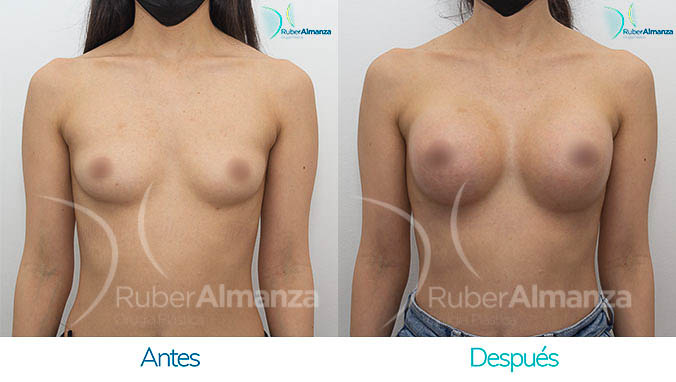 antes-y-despues-mamoplastia-bogota-colombia-dr-ruber-almanza-dmg-frontal