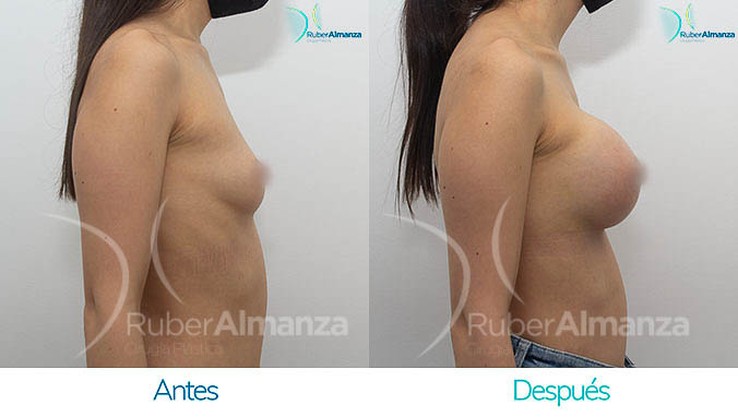 antes-y-despues-mamoplastia-bogota-colombia-dr-ruber-almanza-dmg-lateral-derecho