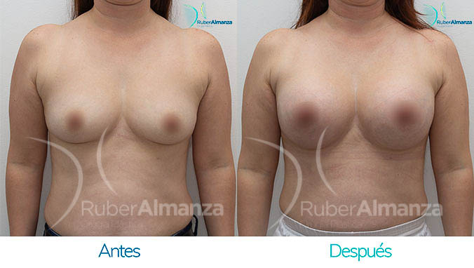 antes-y-despues-mamoplastia-bogota-colombia-dr-ruber-almanza-dms-frontal