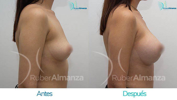 antes-y-despues-mamoplastia-bogota-colombia-dr-ruber-almanza-emr-lateral-derecho