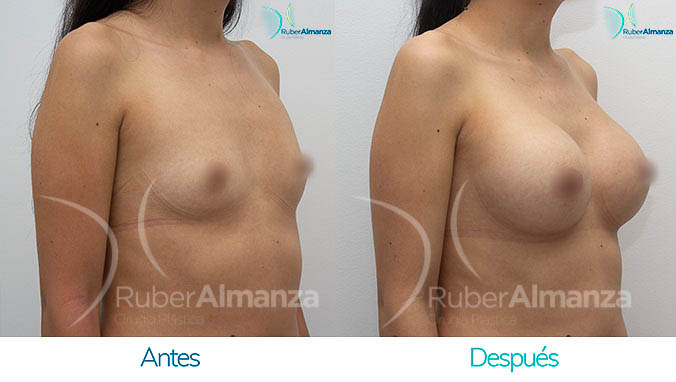 antes-y-despues-mamoplastia-bogota-colombia-dr-ruber-almanza-ic-diagonal-derecho