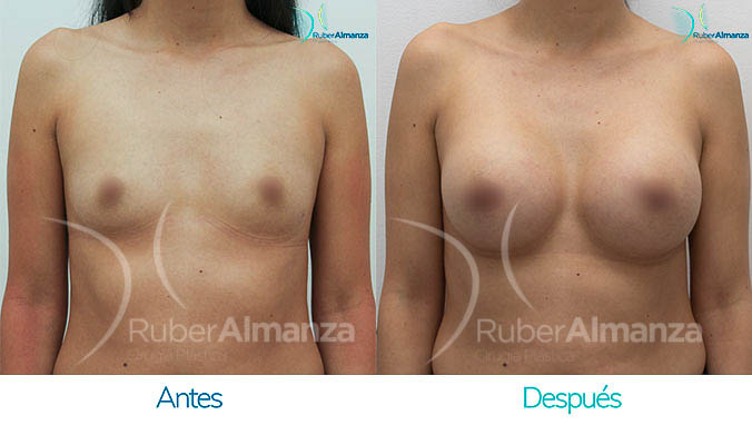 antes-y-despues-mamoplastia-bogota-colombia-dr-ruber-almanza-ic-frontal