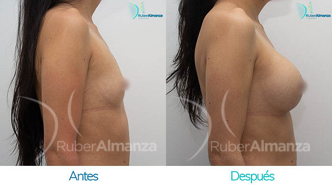 antes-y-despues-mamoplastia-bogota-colombia-dr-ruber-almanza-ic-lateral-derecho