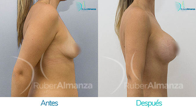 antes-y-despues-mamoplastia-bogota-colombia-dr-ruber-almanza-jcg-lateral-derecho