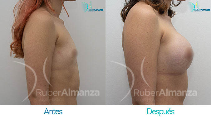 antes-y-despues-mamoplastia-bogota-colombia-dr-ruber-almanza-jh-lateral-derecho