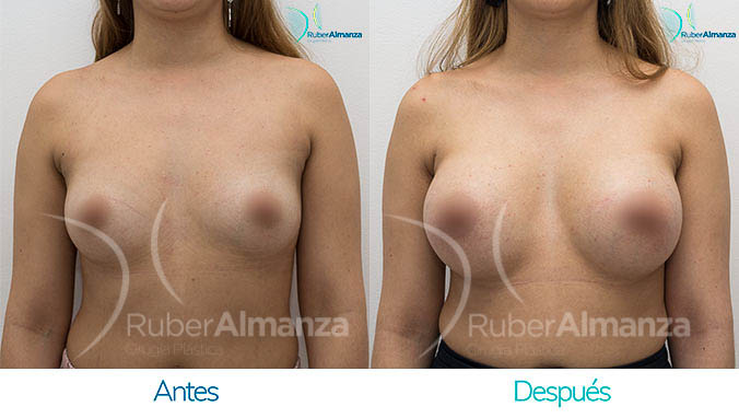 antes-y-despues-mamoplastia-bogota-colombia-dr-ruber-almanza-jm-frontal