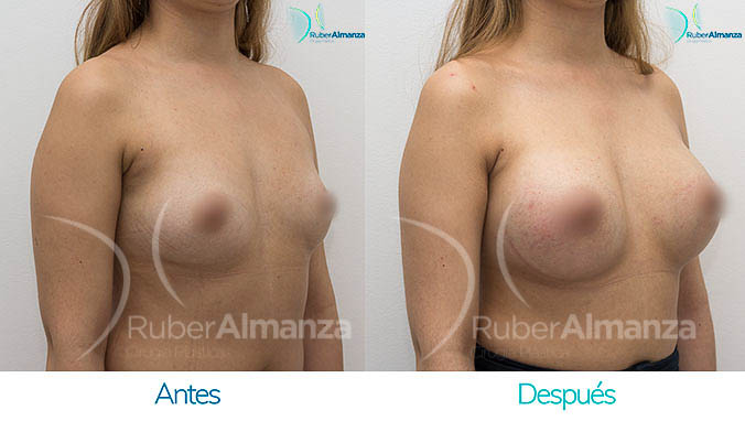 antes-y-despues-mamoplastia-bogota-colombia-dr-ruber-almanza-jm-lateral-derecho