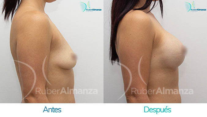 antes-y-despues-mamoplastia-bogota-colombia-dr-ruber-almanza-kjb-lateral-derecho
