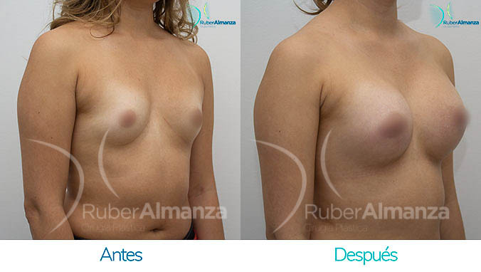 antes-y-despues-mamoplastia-bogota-colombia-dr-ruber-almanza-lfh-diagonal-derecho