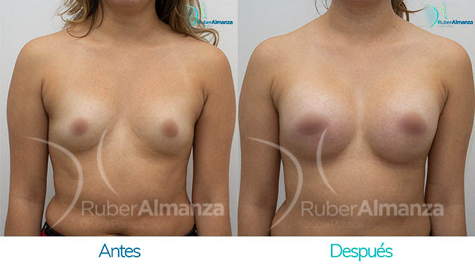 antes-y-despues-mamoplastia-bogota-colombia-dr-ruber-almanza-lfh-frontal
