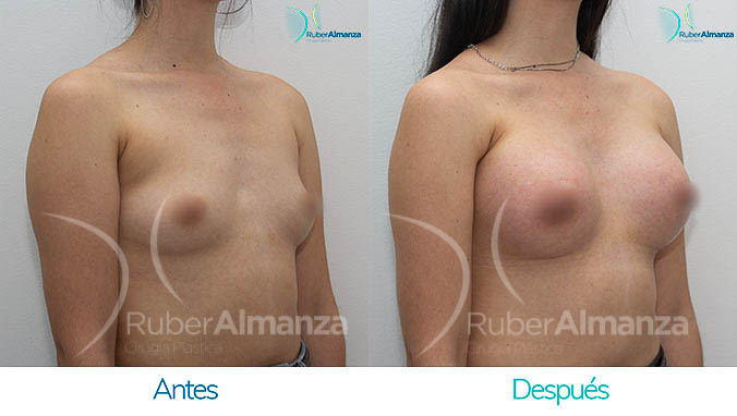 antes-y-despues-mamoplastia-bogota-colombia-dr-ruber-almanza-lnc-diagonal-derecho