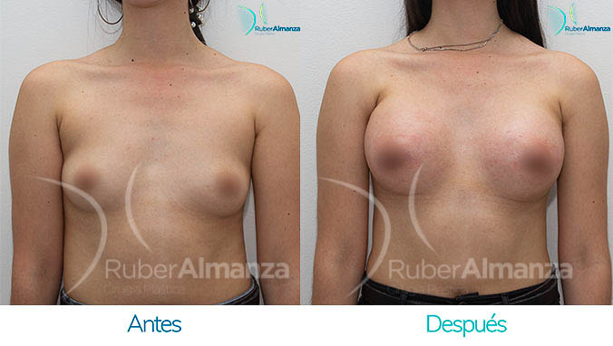 antes-y-despues-mamoplastia-bogota-colombia-dr-ruber-almanza-lnc-frontal