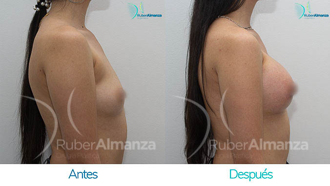 antes-y-despues-mamoplastia-bogota-colombia-dr-ruber-almanza-lnc-lateral-derecho