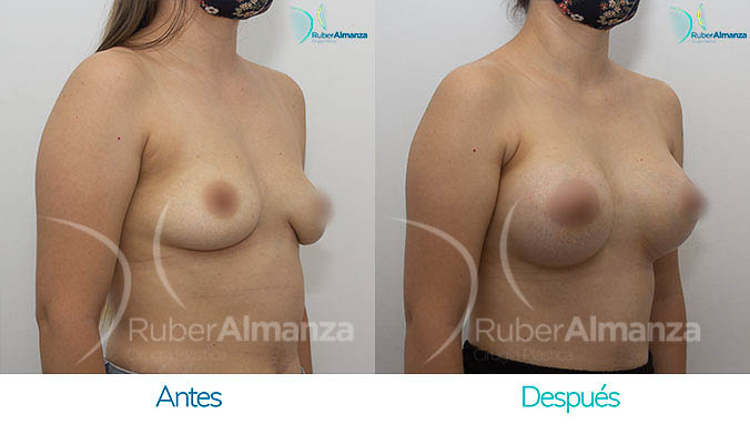 antes-y-despues-mamoplastia-bogota-colombia-dr-ruber-almanza-lp-diagonal-derecho