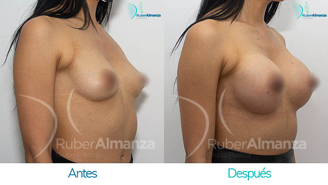 antes-y-despues-mamoplastia-bogota-colombia-dr-ruber-almanza-lrl-diagonal-derecho