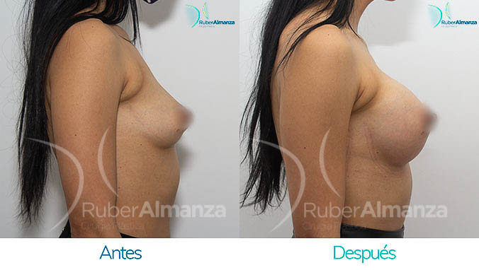 antes-y-despues-mamoplastia-bogota-colombia-dr-ruber-almanza-lrl-lateral-derecho