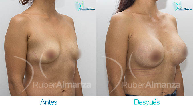 antes-y-despues-mamoplastia-bogota-colombia-dr-ruber-almanza-mj-diagonal-derecho