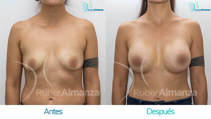 antes-y-despues-mamoplastia-bogota-colombia-dr-ruber-almanza-mj-frontal