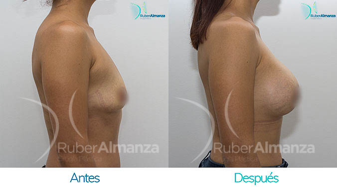 antes-y-despues-mamoplastia-bogota-colombia-dr-ruber-almanza-mj-lateral-derecho