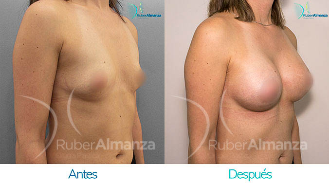 antes-y-despues-mamoplastia-bogota-colombia-dr-ruber-almanza-ng-diagonal-derecho