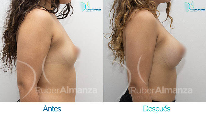 antes-y-despues-mamoplastia-bogota-colombia-dr-ruber-almanza-tp-lateral-derecho