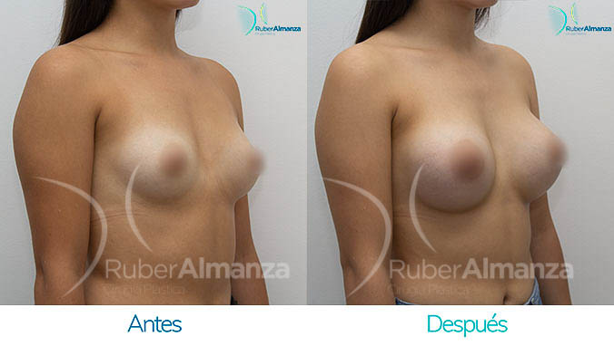 antes-y-despues-mamoplastia-bogota-colombia-dr-ruber-almanza-vm-diagonal-derecho