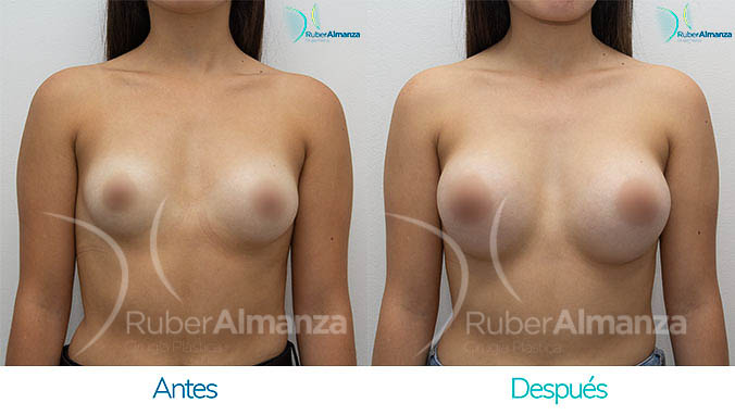 antes-y-despues-mamoplastia-bogota-colombia-dr-ruber-almanza-vm-frontal