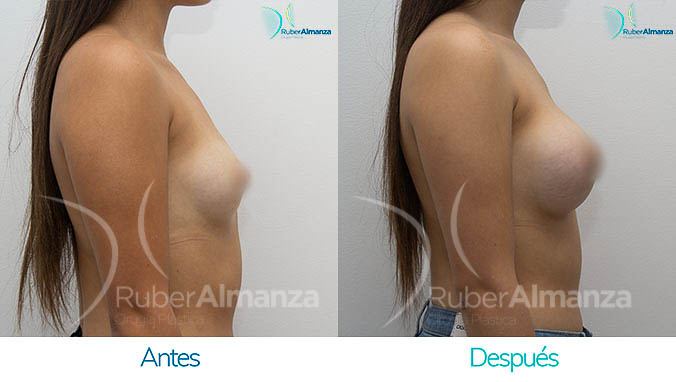 antes-y-despues-mamoplastia-bogota-colombia-dr-ruber-almanza-vm-lateral-derecho