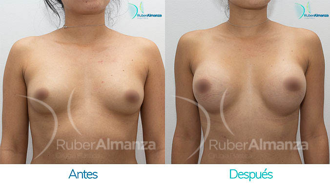 antes-y-despues-mamoplastia-bogota-colombia-dr-ruber-almanza-yc-frontal